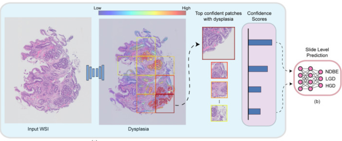 AI in the assessment of Barrett's neoplasia