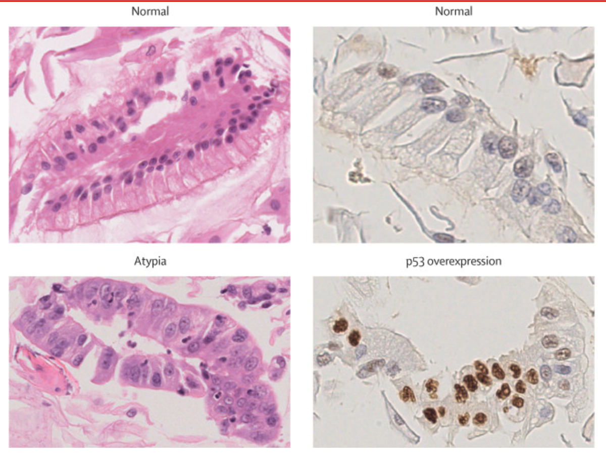 Tension between risk-based and patient-centered esophageal cancer screening