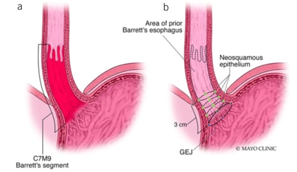 Significant updates to Barrett's screening, surveillance and treatment guidelines